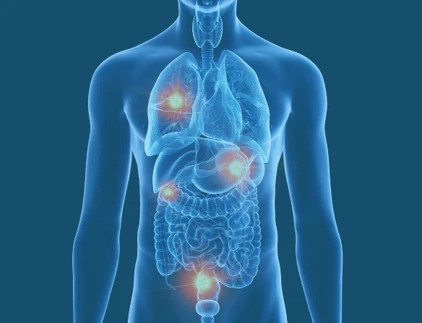 Illustration of cancer spreading to multiple organs